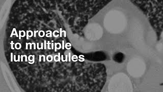 Algorithmic Approach to Multiple Lung Nodules [upl. by Ssej]