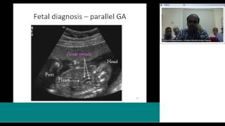 dTGA diagnosis and preoperative assessment by Dr Sivakumar [upl. by Helbona227]