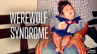 Living with ‘Werewolf Syndrome’  Sunday Night Archive [upl. by Nilhtac]