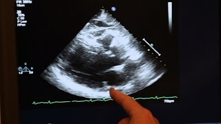 Echocardiogram Demonstration [upl. by Lramaj]