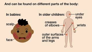 Does My Child have Eczema  American Academy of Pediatrics AAP [upl. by Eyatnod]