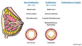 Breast Disease  Risk Lesions Pt 1 [upl. by Malkah]