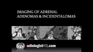 Laparoscopic Adrenalectomy for a Right Sided CortisolSecreting Adenoma  Preview [upl. by Anauqaj870]