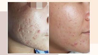 REAL and LEGIT ACNE SCARS TREATMENT SOLUSYON SA ACNE SCARS  ACNE SCAR REMOVAL AcneScarJourney [upl. by Blood524]