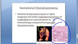 Pathology 750 b ChorioCarcinoma Placenta Gestational hCG tumor malignant molar pregnancy [upl. by Kalinda]