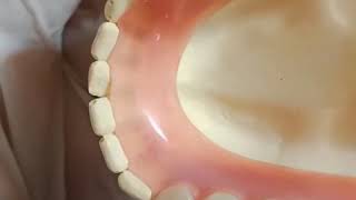 VALPLAST FLEXIBLE DENTURE [upl. by Mudenihc115]