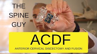 CERVICAL STENOSIS RADICULOPATHY  PART 5  ACDF [upl. by Moon]