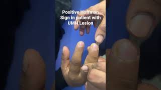 Positive Hoffman Sign in patient with UMN lesion [upl. by Anitnelav]