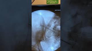 SacroIliac Joint Injection [upl. by Nolan]