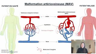 Maladie de RenduOslerWeber  ExpoSciences 2021 [upl. by Marga]