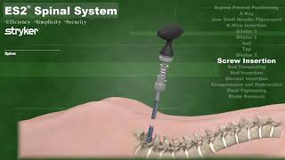 Stryker ES2 Percutaneous Spinal System for Minimally Invasive Procedures [upl. by Ainoz]