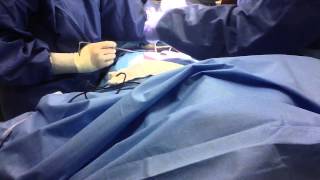 Part 1 of Bowel Resection Surgical Technology [upl. by Stelu]