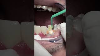 Composite with fiber post dentist [upl. by Enrahs]