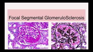 Glomerulonephritis [upl. by Jopa391]