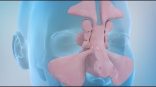 Sinusitis and Sinus Surgery Explained Balloon Sinuplasty and Endoscopic Sinus Surgery [upl. by Noyerb]