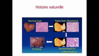 steatose hepatique comment détecter et suivre les patients à risque [upl. by Eesyak]