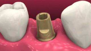 Restoring dental implants video BioHorizons [upl. by Oster]