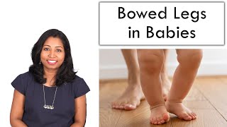 Bowed Legs in Babies – Reason amp Cure [upl. by Enalda]