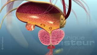 PROSTATE adenome traitement chirurgical LASER RTUP [upl. by Aninat840]