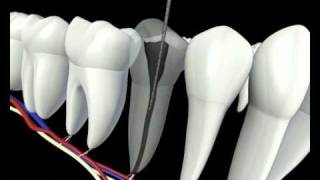 Root Canal Procedure 3D Animation  Endodontics Los Angeles [upl. by Tripp802]