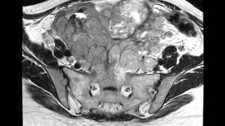 CT Scan Abdomen and Pelvis of Uterine Cancer [upl. by Hightower25]