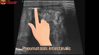 Necrotizing enterocolitis NEC complicated by Perforated Bowels Dr Mohamed Soliman [upl. by Acinomahs]