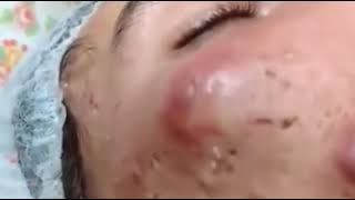 Big Acne Pus on face pop out Really hurt and terrified [upl. by Huberman523]