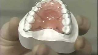 Diastema Closure  Hawley Retainer [upl. by Neslund]