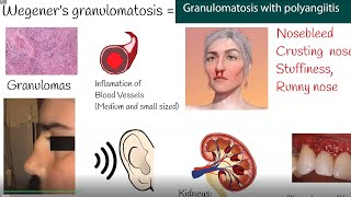 Wegeners granulomatosis  Granulomatosis with polyangiitis  Symptoms and causes [upl. by Lidda]