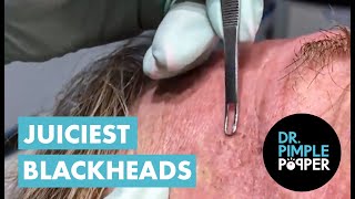 Juicy Blackheads Extracted by Dr Pimple Popper [upl. by Anhpad232]