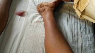 Hypothyroidism Woltmans sign Delayed relaxation of bilateral ankle jerk Myxoedema [upl. by Issiah]