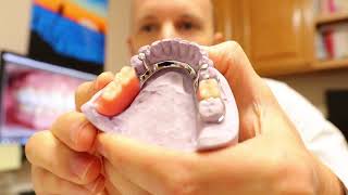 Denture RelineIt Tutorial No Bad Taste Method [upl. by Vins]