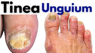 Tinea unguium infection  nail fungus treatment at home  Nail fungus symptoms and treatment [upl. by Wightman559]