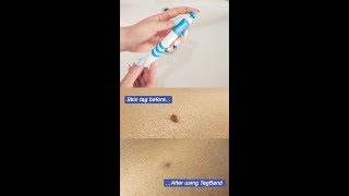 Wait till the end Removing skin tags from home using TagBand amazongadgets [upl. by Sergent369]