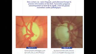 meilleures explication des glaucomes 🤩🤩 ophtalmologie  ECN [upl. by Avat]