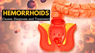 Hemorrhoids or Piles CausesSigns and symptoms Diagnosis and Treatment [upl. by Eimmot647]