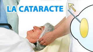 La cataracte expliquée par Dr Stopek [upl. by Nwahsir]