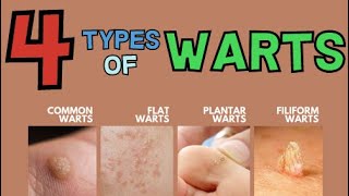 THE 4 MAIN TYPES OF WARTS [upl. by Michaud]