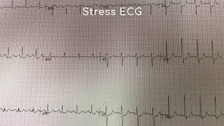 Resting ECG vs Stress ECG [upl. by Laddy]