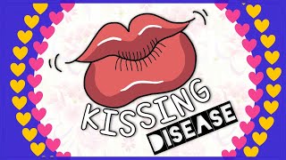 Infectious mononucleosis Kissing disease Diagnosis Clinical feature Treatment [upl. by Redwine]