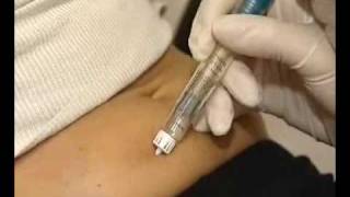 How to give a lucrin injection [upl. by Madalyn]