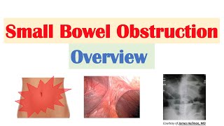 How to Get Rid of Bowel Obstruction [upl. by Mezoff]