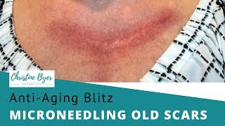 Scars How to Use Microneedling or Dermaroller at Home to Reduce the Appearance of Scars [upl. by Beera772]