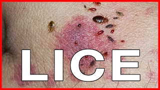 Pubic Lice or Crabs Info about Transmission Treatments Cure and Pictures [upl. by Rebliw382]