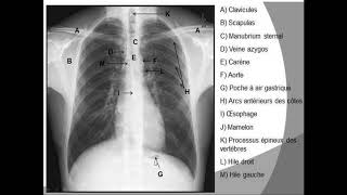 le visible et linvisible sur une radiographie thoracique [upl. by Maxie]