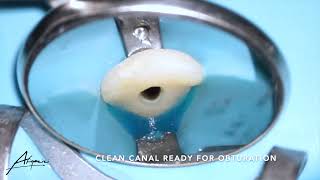 Root canal treatment on the maxillary central incisor tooth 21 [upl. by Novelc]