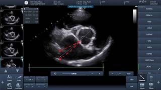 Video 1  How to perform basic echocardiographic measurements  LAAo [upl. by Niroht172]