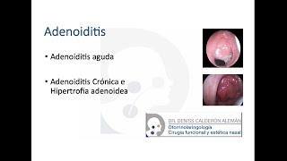 4 Adenoiditis [upl. by Naed]