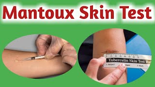 Mantoux test  Tuberculin skin test  Tuberculin test [upl. by Akialam]