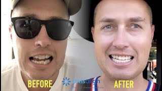 Invisalign Review  Invisalign Before And After [upl. by Poland]